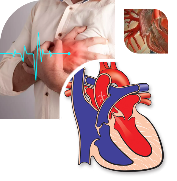 mitral aortic stenosis